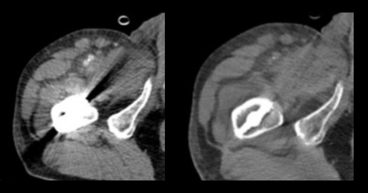 (ซ้าย: ภาพ CT ทั่วไป / ขวา: ภาพ Spectral CT)