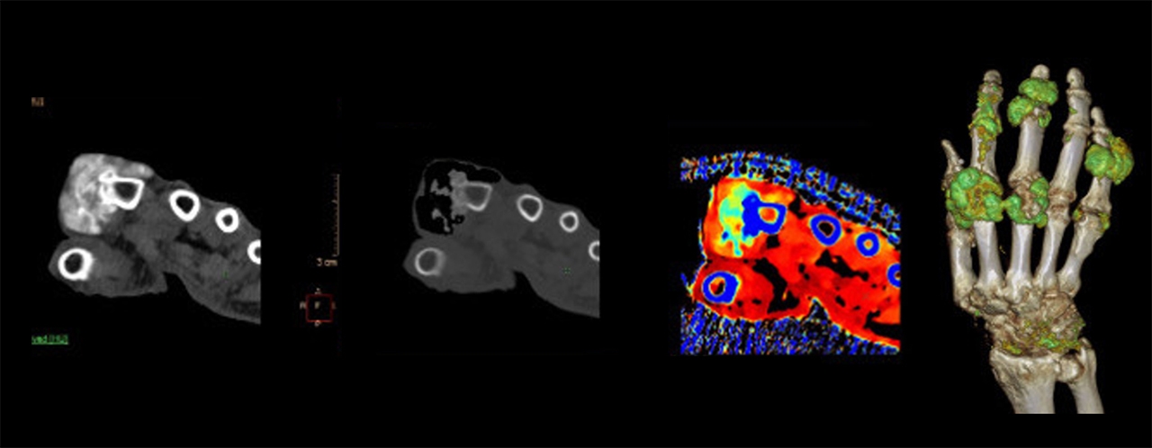 (ซ้าย: ภาพ CT ทั่วไป / ภาพที่ 2-4 จากซ้าย: ภาพ Spectral CT)