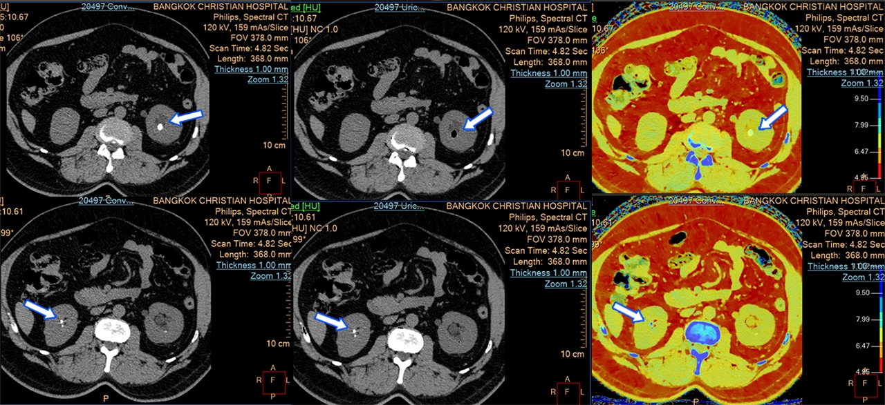 (แถวซ้าย: ภาพ CT ทั่วไป / แถวกลางและขวา: ภาพ Spectral CT)
