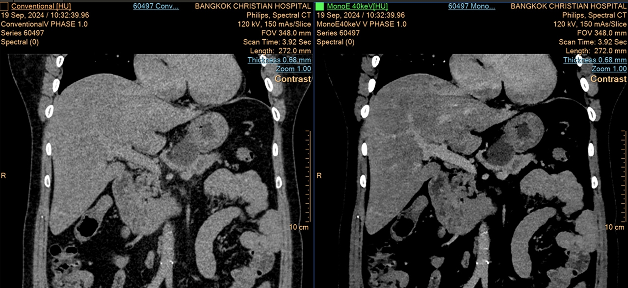 (ซ้าย: ภาพ CT ทั่วไป / ขวา: ภาพ Spectral CT)
