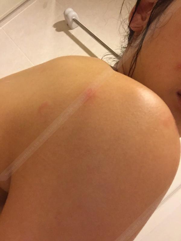 โชว์บาดแผล