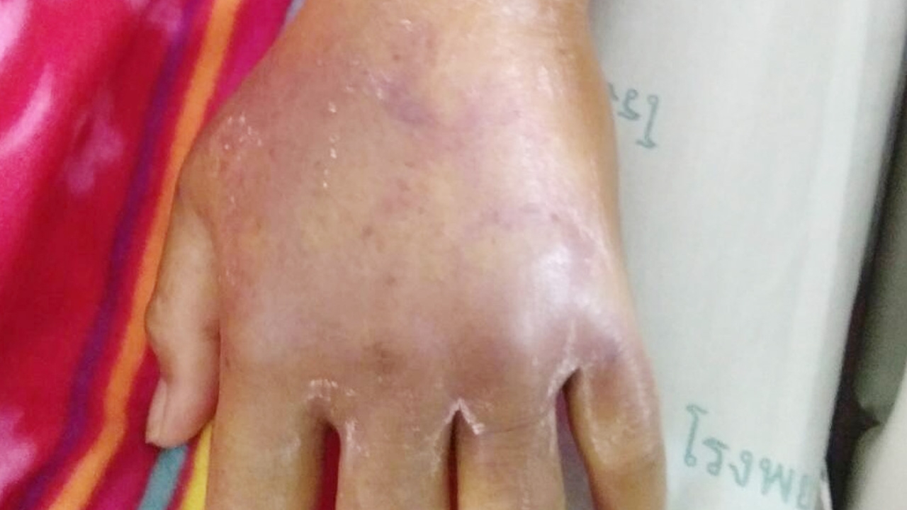 หญิงถูกแมงมุมกัดสาหัส มีโรคแทรกซ้อน ผ่าตัด หัวใจหยุดเต้น ปั๊มช่วย 4 รอบ