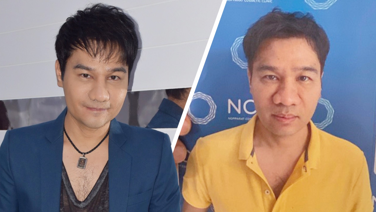 เปิดลิสต์ชัดๆ ใบหน้า กอล์ฟ เบญจพล ก่อน-หลังทำศัลยกรรม ทำอะไรไปบ้าง