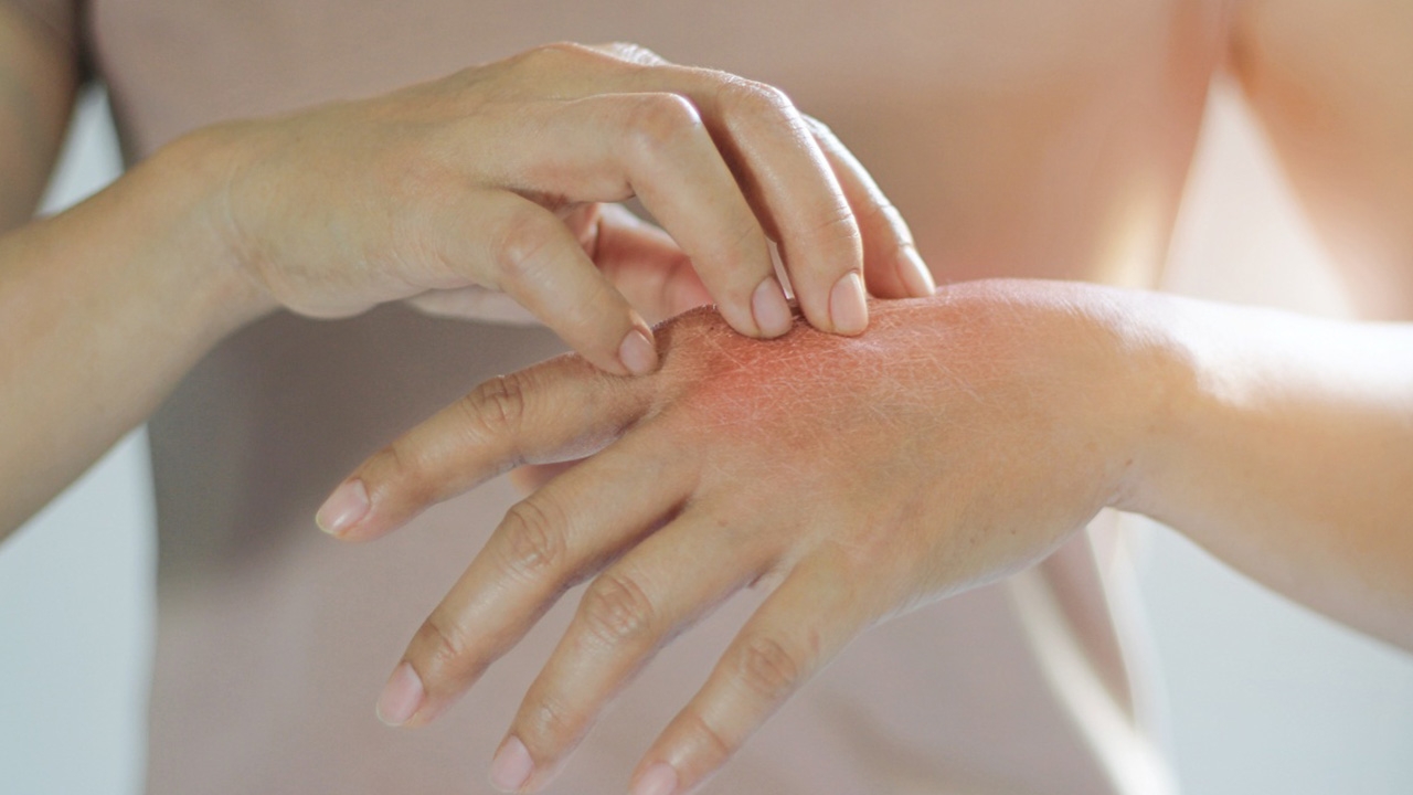 แพทย์ผิวหนัง ชี้ "โรคเพมฟิกัส" รักษาหายได้ แนะวิธีดูแลป้องกันตัวเอง