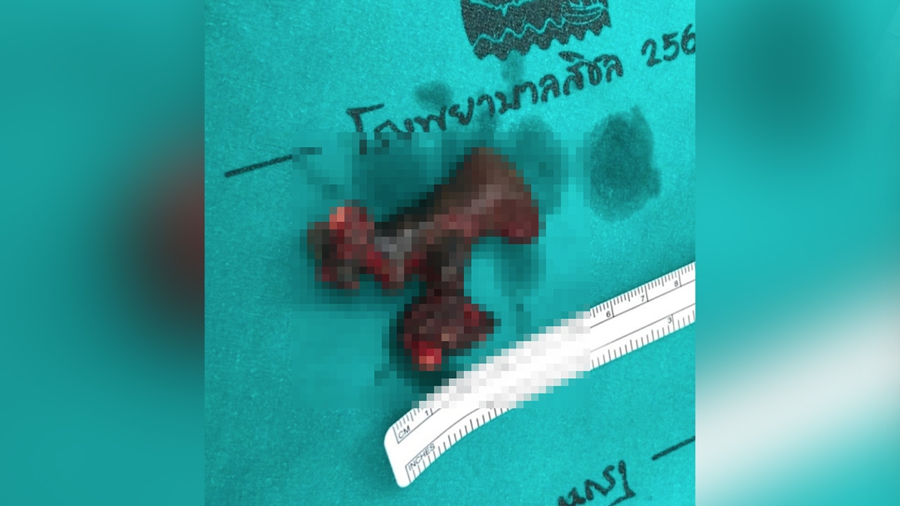 นิ่วในไต อันตรายถึงชีวิต แนะดื่มน้ำสะอาดมากๆ เลี่ยงอาหารที่มียูริค