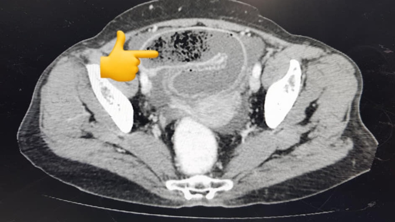 เตือนภัย กินส้มตำแล้วไม่เคี้ยว สุดท้ายเส้นมะละกอรวมเป็นก้อน อุดตันลำไส้เล็ก