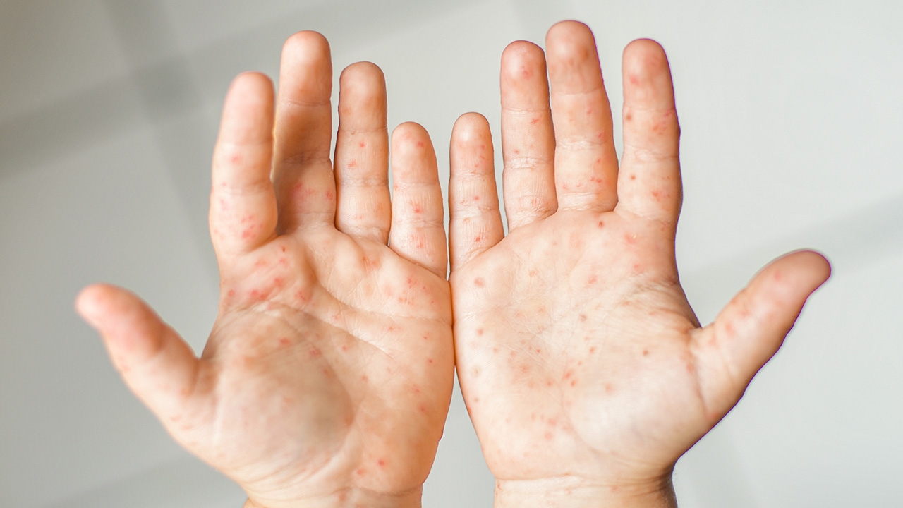 5 โรคสุดฮิต เตือนพ่อแม่ดูแลลูก รับวันเปิดเทอม 1 ก.ค.63