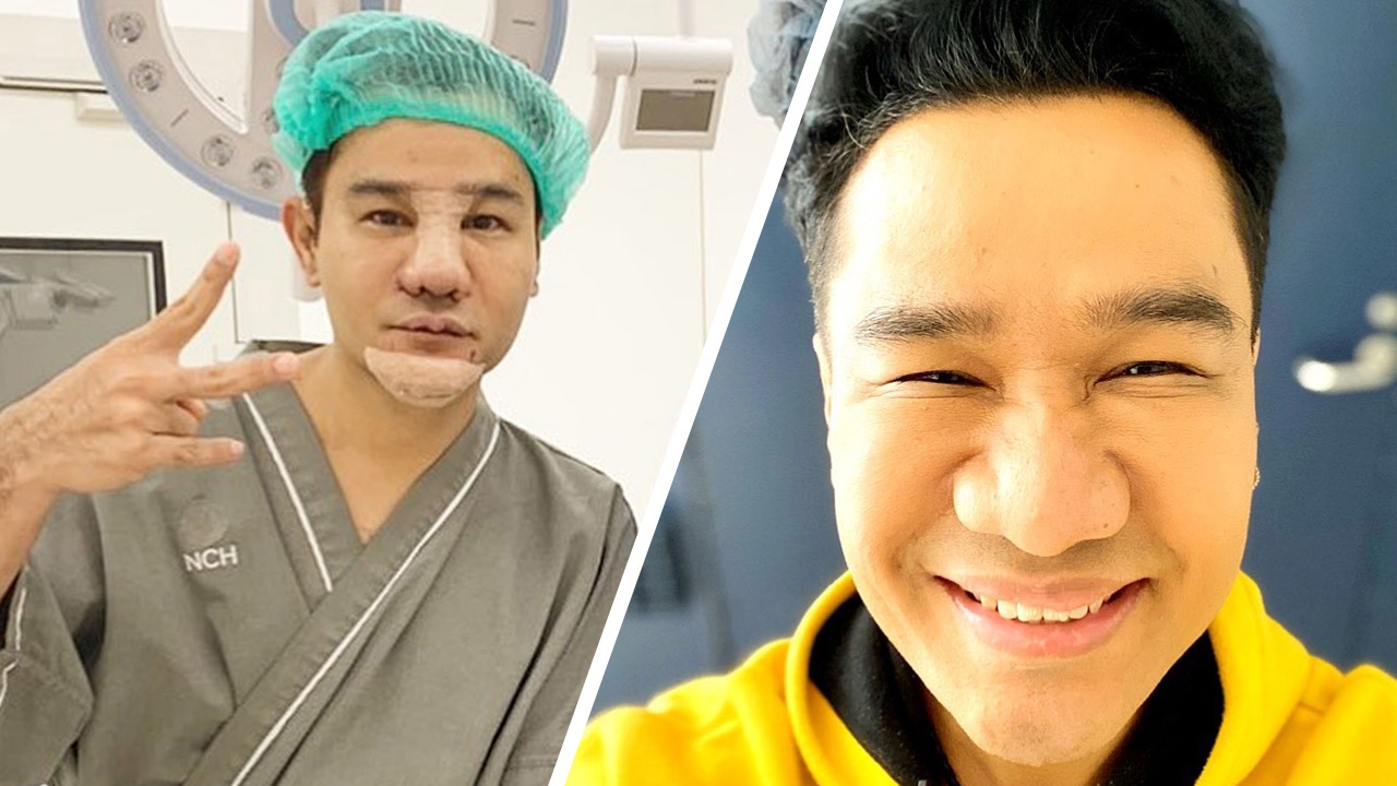 กอล์ฟ เบญจพล เตรียมอวดโฉมหน้าใหม่ หลังขึ้นเขียงให้หมอเสริมหล่อ