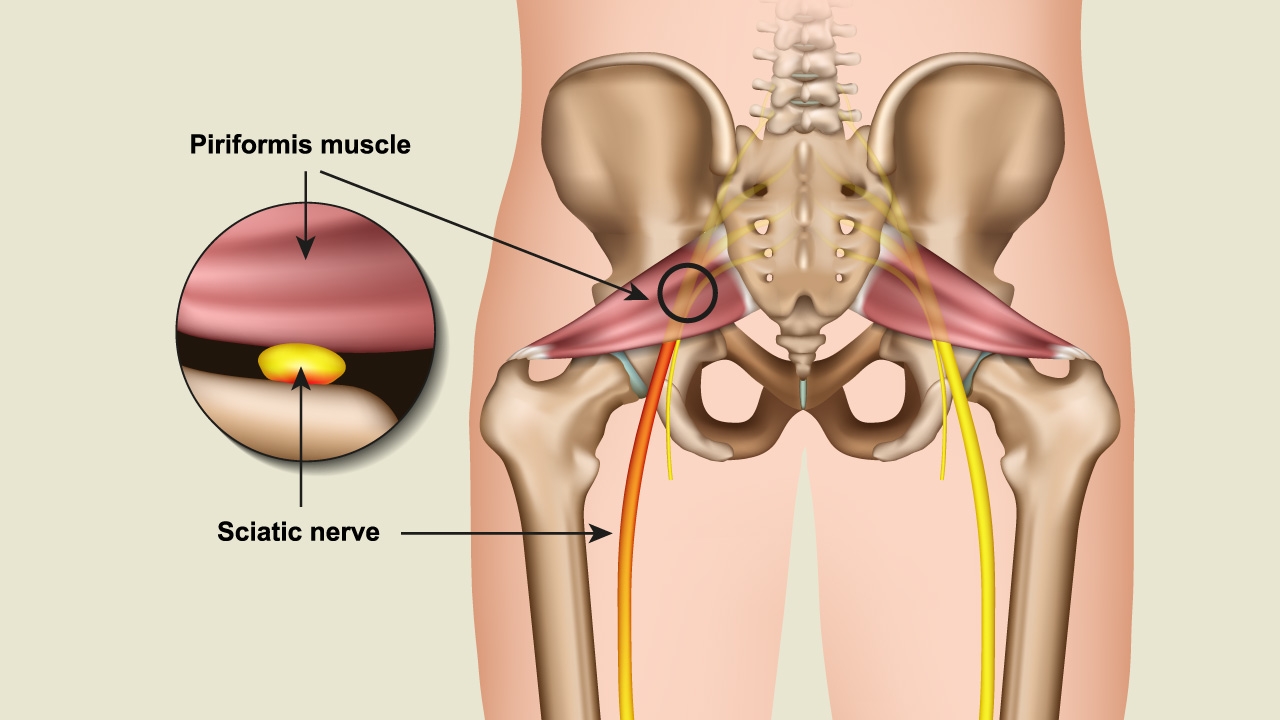 ศุกร์สุขภาพ : “Piriformis Syndrome” โรคที่คนวัยทำงานควรรู้จัก