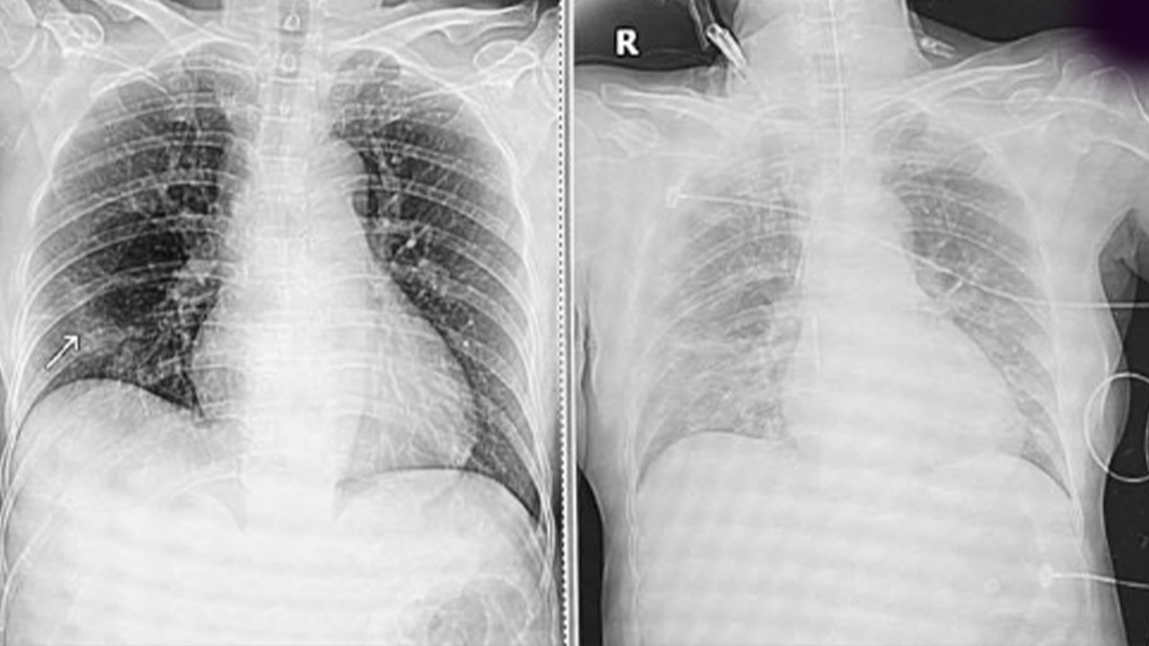 ลูกกลับจากเมืองนอกไม่กักตัว ทำแม่ติดโควิด-19 อยู่ไอซียู ใช้เครื่องช่วยหายใจ