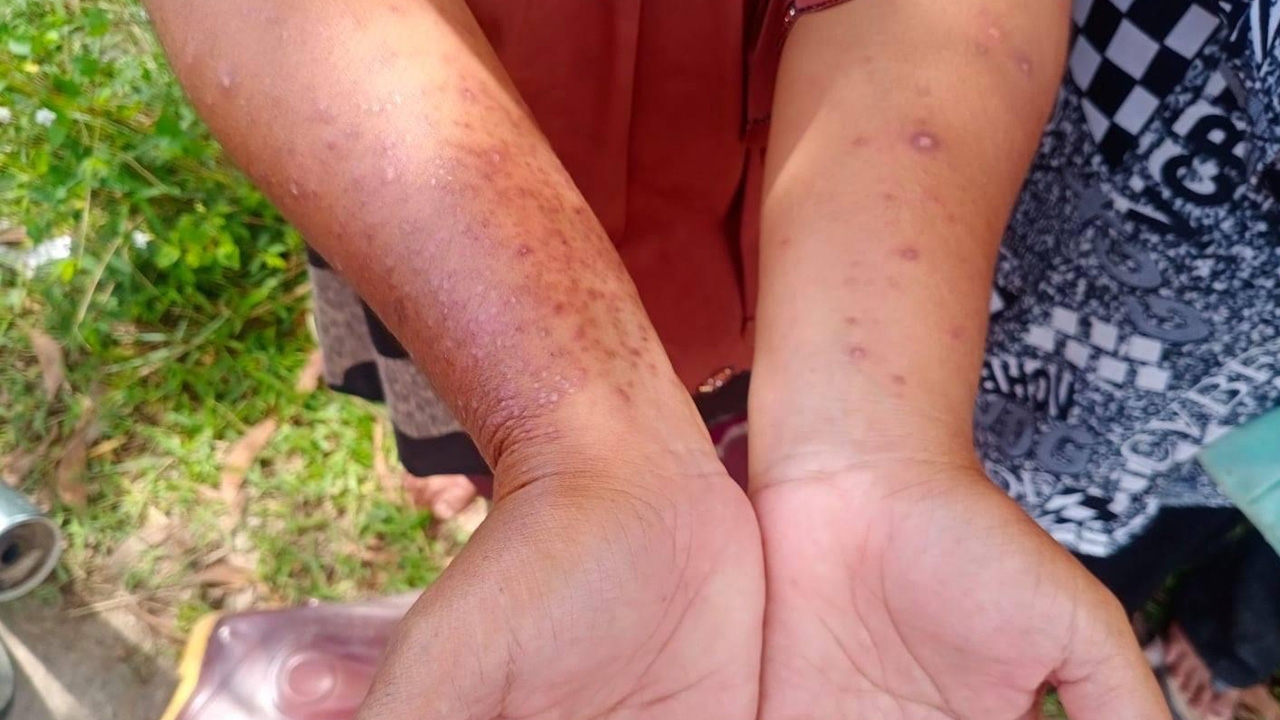 รพ.จะนะ รับมือผู้ป่วยโรคหอยคัน ศึกษาปัจจัยการระบาด ป้องกันชาวนาระยะยาว