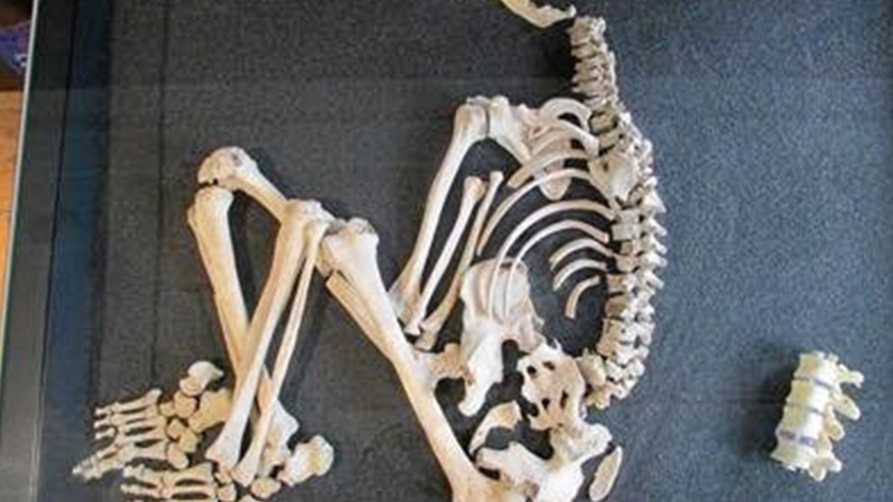 ไขที่มา ของบุรุษยุคเหล็กผู้ป่วยวัณโรค