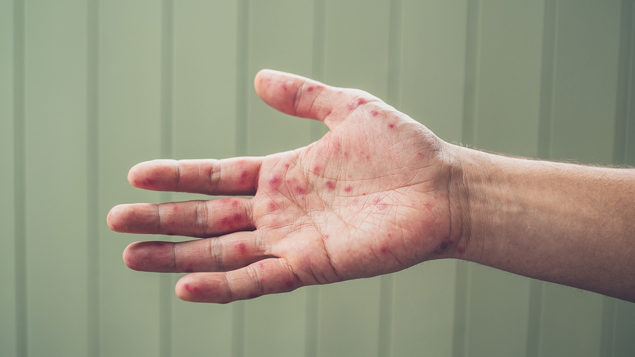 โรคมือ เท้า ปาก ยังไม่มีวัคซีนป้องกัน อาการไม่รุนแรง สามารถหายเองได้