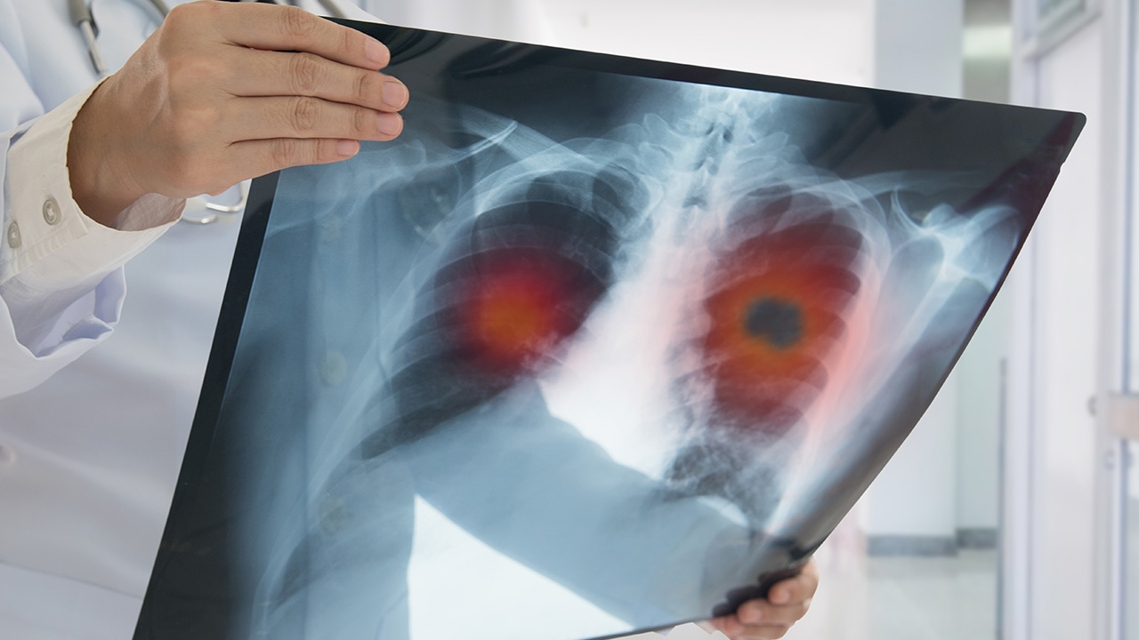 มะเร็งปอด พบบ่อยในคนไทย ระยะแรกมักไม่มีอาการ ชี้ปัจจัยเสี่ยงสำคัญก่อโรค