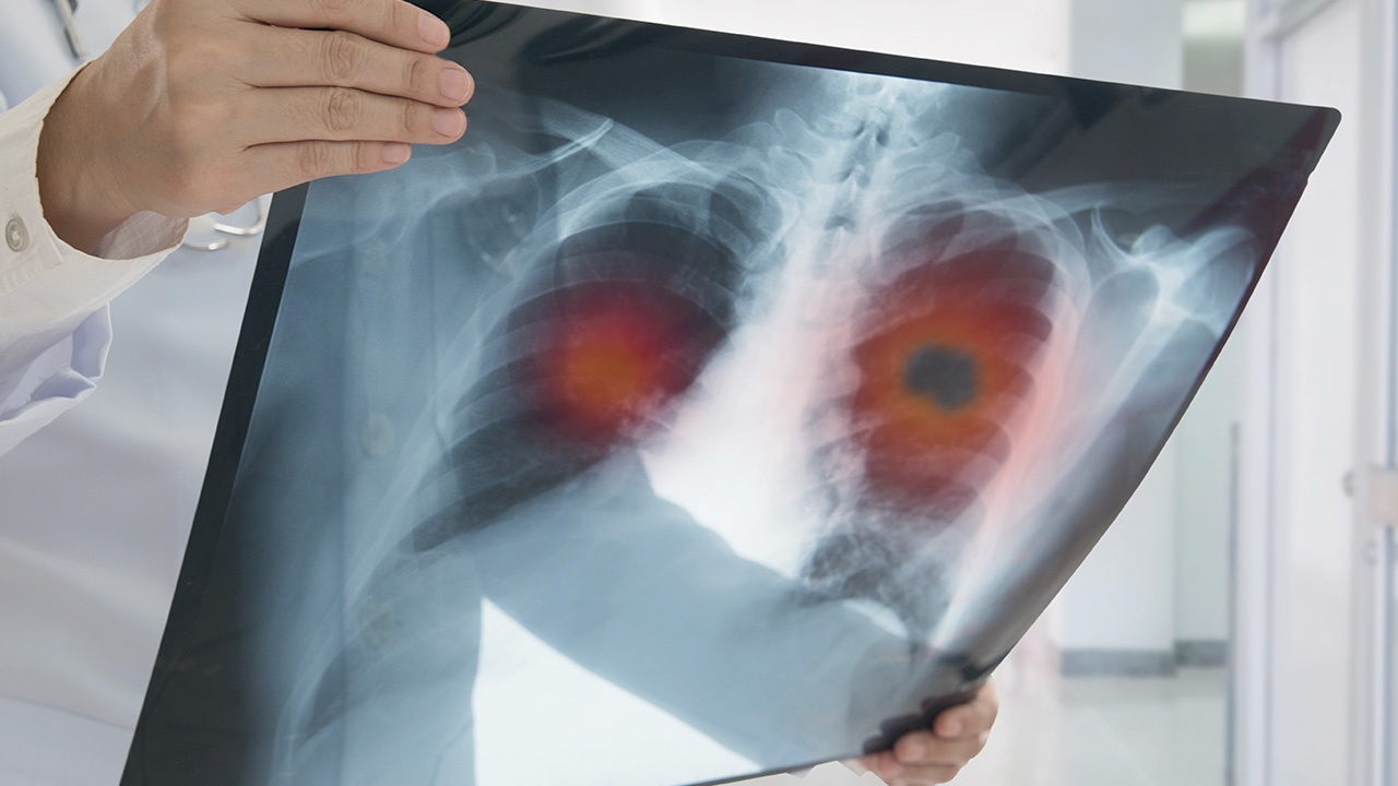 มะเร็งปอด โรคใกล้ตัวพบบ่อย แพทย์ชี้สัญญาณเตือนโรค แนะวิธีป้องกัน