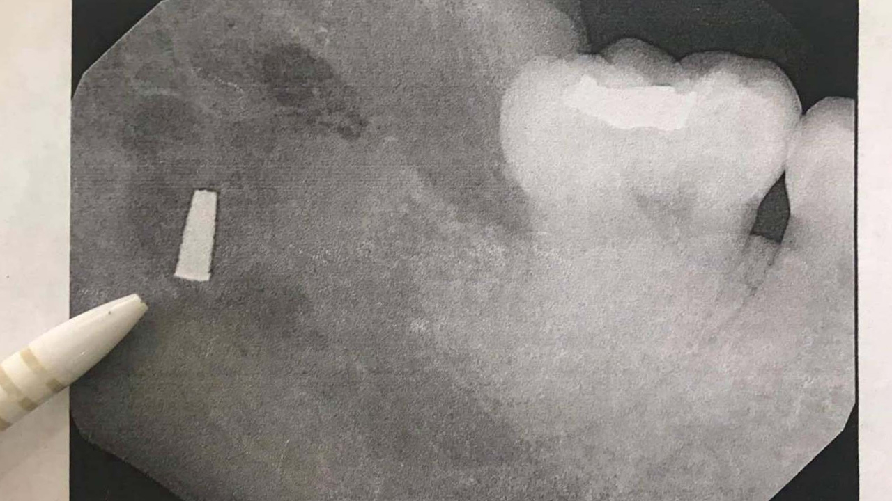 สาวเตรียมฟ้อง ปมทันตแพทย์ ลืมหัวกรอฟันในเหงือก 5 ปี อ้างทำร่างกายผิดปกติ