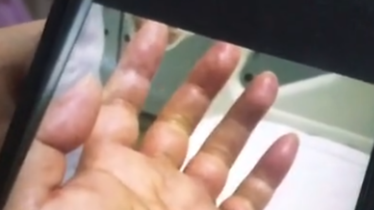 หนุ่มจีนก้างปลาตำนิ้ว ติดเชื้อแบคทีเรียกินเนื้อคน สุดท้ายโดนตัดมือทิ้ง