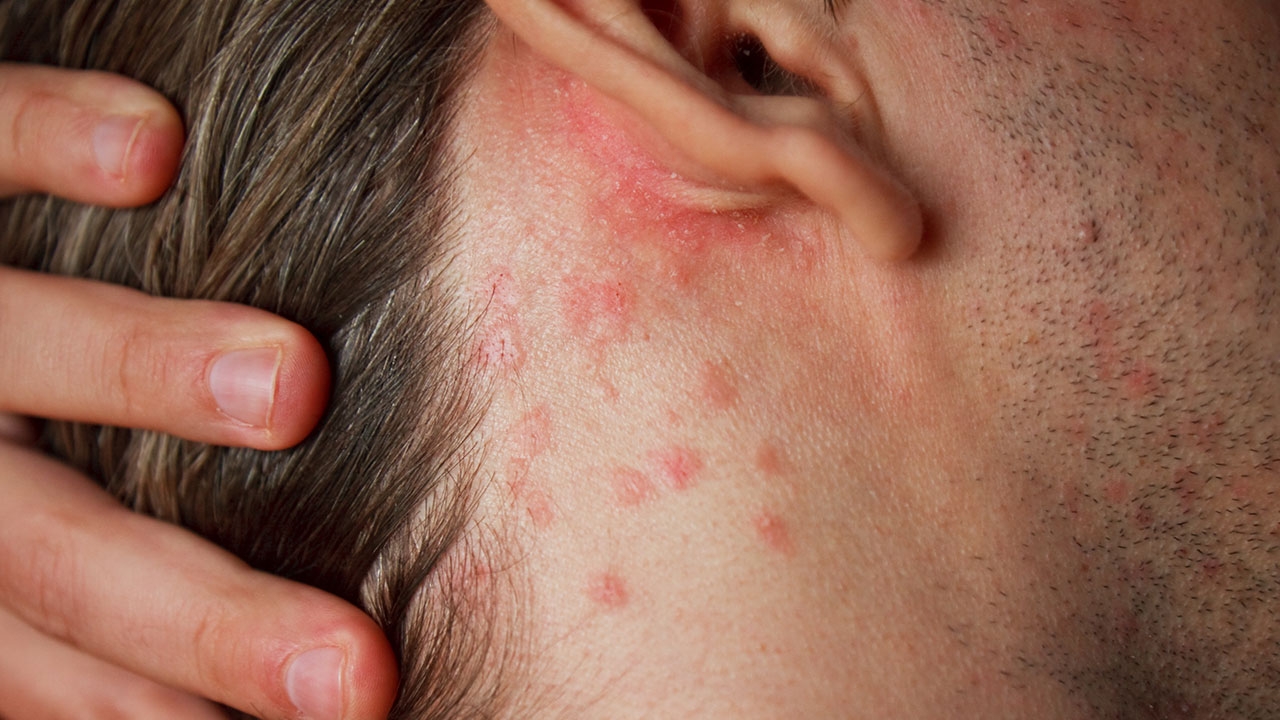 เป็นโรคสะเก็ดเงินเรื้อรังมีความเสี่ยงภาวะหัวใจวาย