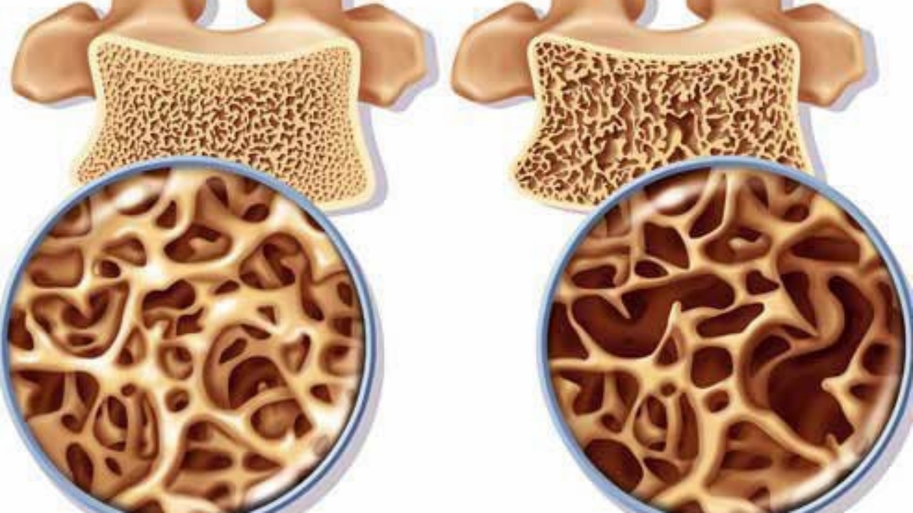แพทย์เตือน ดื่มสุรา-กาแฟ-สูบบุหรี่ เสี่ยงเป็นกระดูกพรุน-หัก