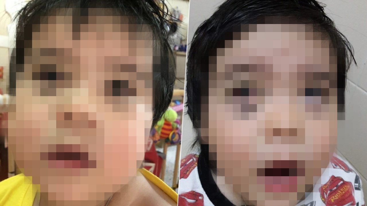 แม่ช็อก! พาเด็กแฝดไปดูดเสมหะที่ รพ. แต่ทำไมหน้าแหก เส้นเลือดในตาแตก