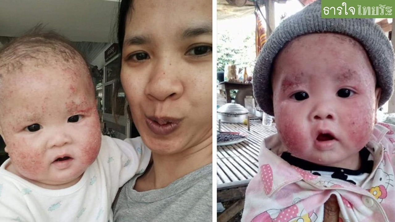 ชีวิต ด.ช.8 เดือนสุดทรมาน แพ้นมน้ำเหลือง-เลือดซึมตัว วอนใจบุญช่วยเหลือ