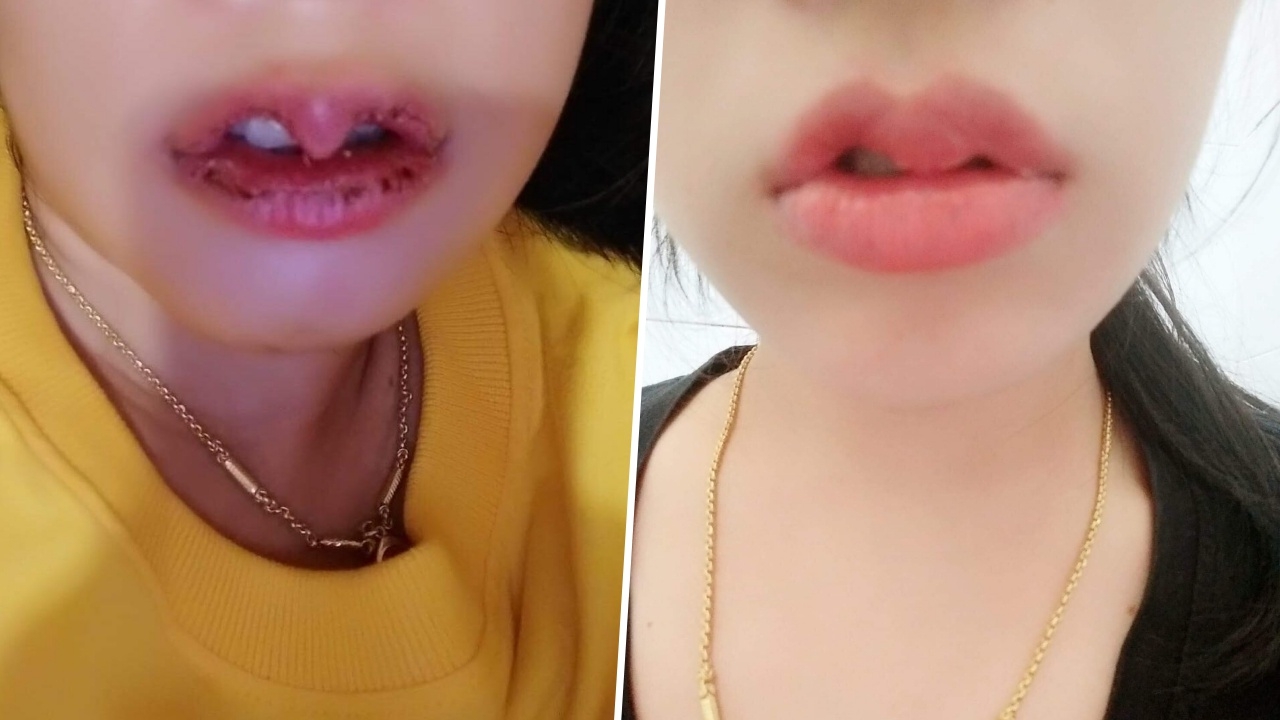 แทนที่จะสวย! เพจดังโพสต์อุทาหรณ์สาวทำปากกระจับ คนผ่าตัดไม่ใช่แพทย์
