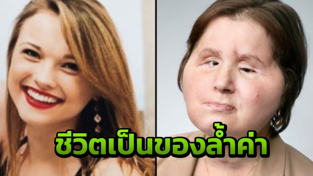 สาวฆ่าตัว-ไม่ตาย เสียโฉมหนัก ปลูกถ่ายใบหน้าแล้ว  รู้ซึ้งชีวิตล้ำค่า 