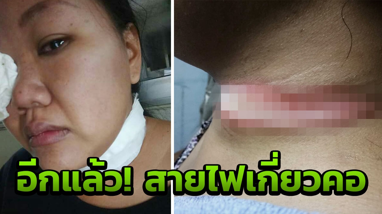 หวิดดับ! สายไฟเกี่ยวคอสาวเบญจเพส จยย.ล้มคว่ำ เป็นแผลยาวเกือบ 20 ซม.
