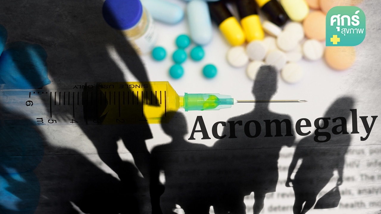 มารู้จัก “โรคอะโครเมกาลี” กันเถอะ (ตอน 1)