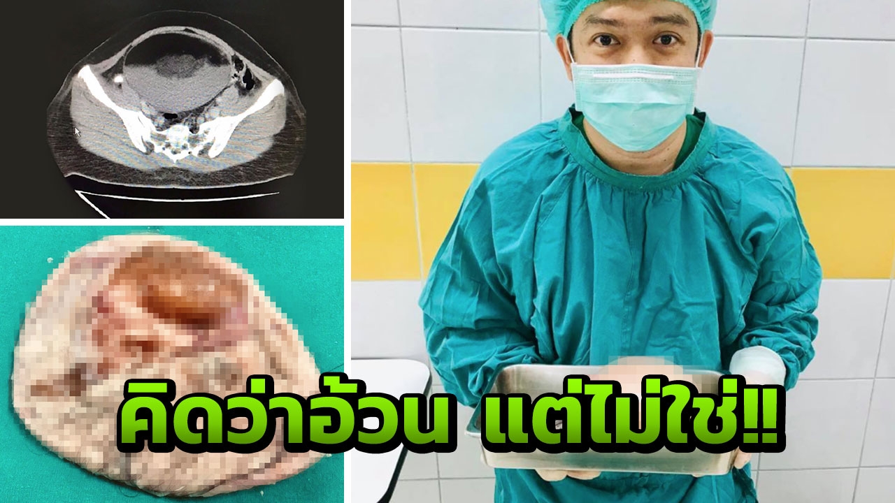ไม่ได้อ้วน สาวตรวจเจอถุงน้ำรังไข่ที่ท้องน้อย ผงะ! ภายในมีผม กระดูก ฟัน