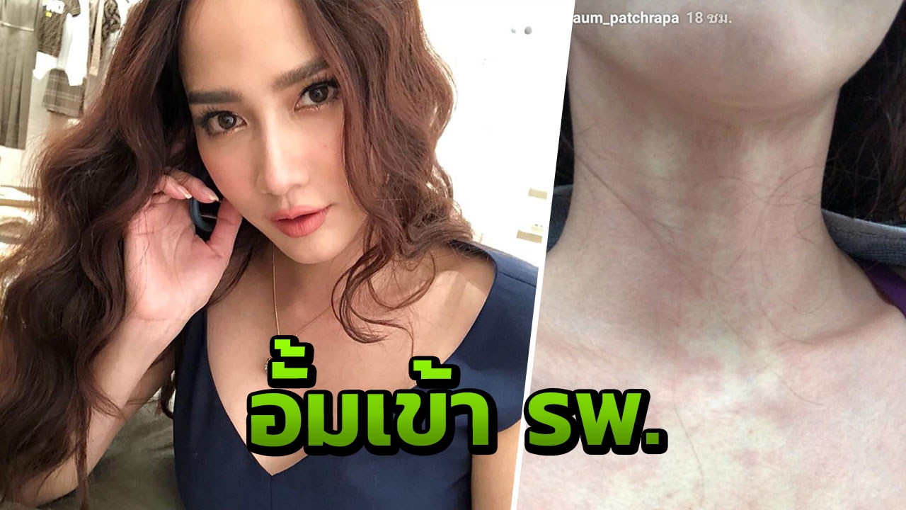 แฟนคลับห่วง อั้ม พัชราภา แอดมิท รพ. หลังผื่นแดงขึ้นเต็มไปหมด