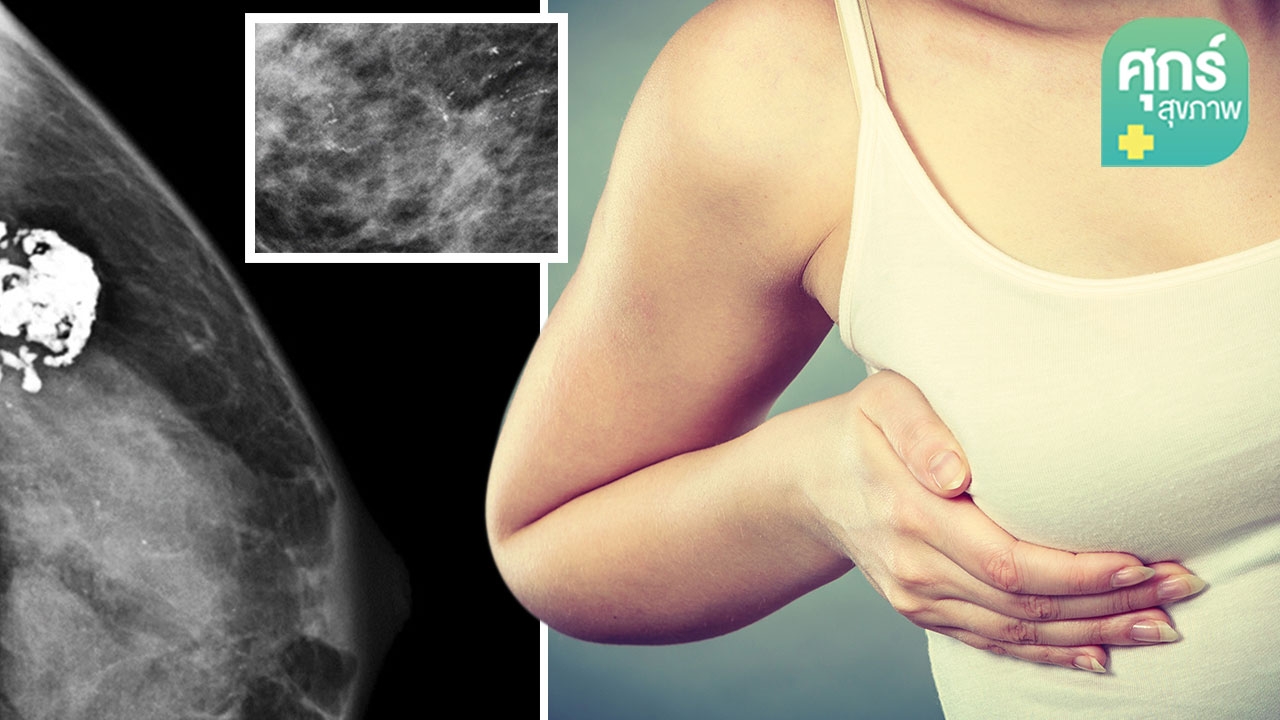 “หินปูนที่เต้านม” เรื่องที่ผู้หญิงทุกคนควรรู้จัก