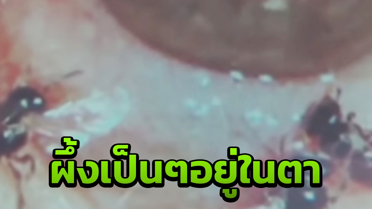หมอไต้หวันอึ้ง เจอผึ้งเป็นๆ 4 ตัว อาศัยอยู่ในดวงตาคนไข้หญิง (คลิป)