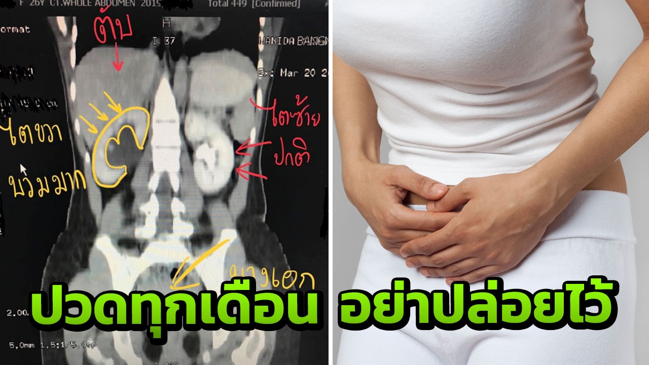 ปวดท้องขณะมีรอบเดือน อาจไม่ปกติ สาวป่วยเยื่อบุโพรงมดลูกเจริญผิดที่ เสี่ยงไตวาย