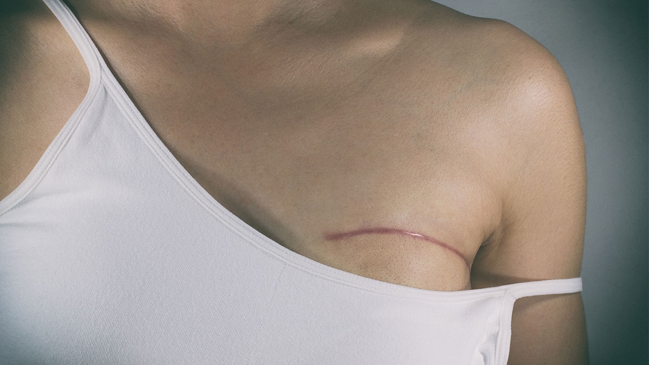 ศัลยกรรมทำพิษ สาวลาวหน้าอกติดเชื้อน้ำหนองไหล สุดท้ายต้องตัดยอดปทุมถัน