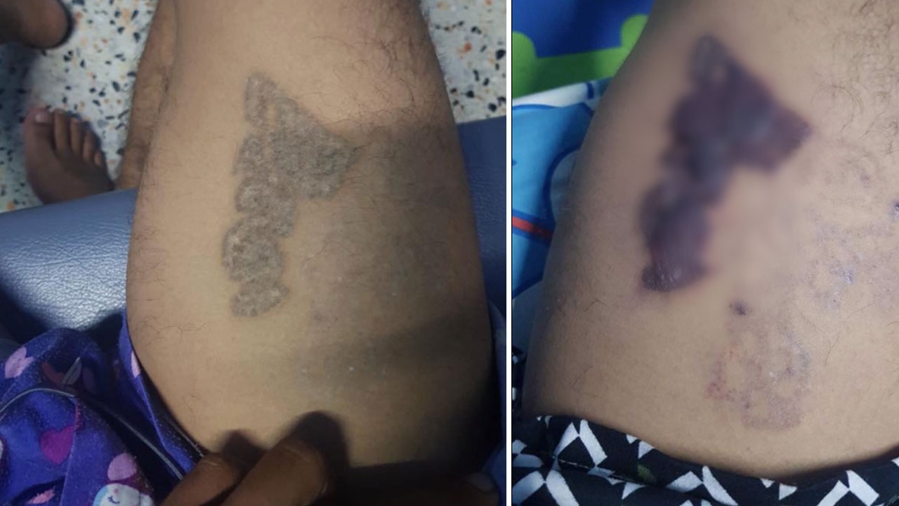 เจ็บเหมือนโดนหนังยางดีดแผลสด หนุ่มเล่าลบรอยสัก เพราะอยากรับราชการ