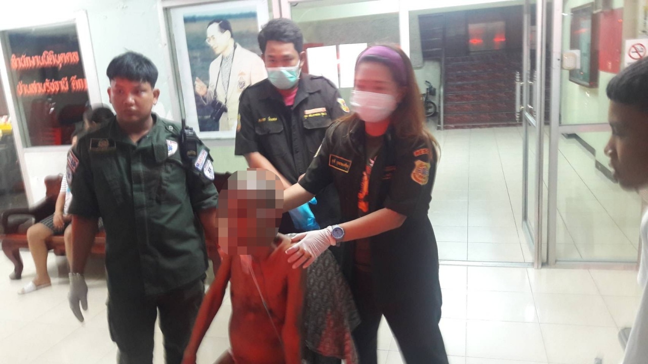 พ่อเมาเหล้าขาว ราดน้ำมันจุดไฟเผาลูกนอนป่วยคาคอนโด อาการสาหัส
