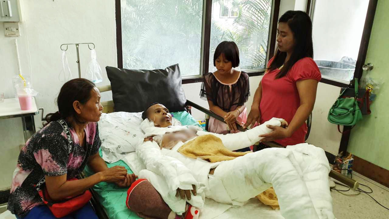 สุดทรมาน หนุ่มป่วย"หนังเน่า" รับจ้างฉีดยาฆ่าหญ้า ซึมซาบสารเคมี 