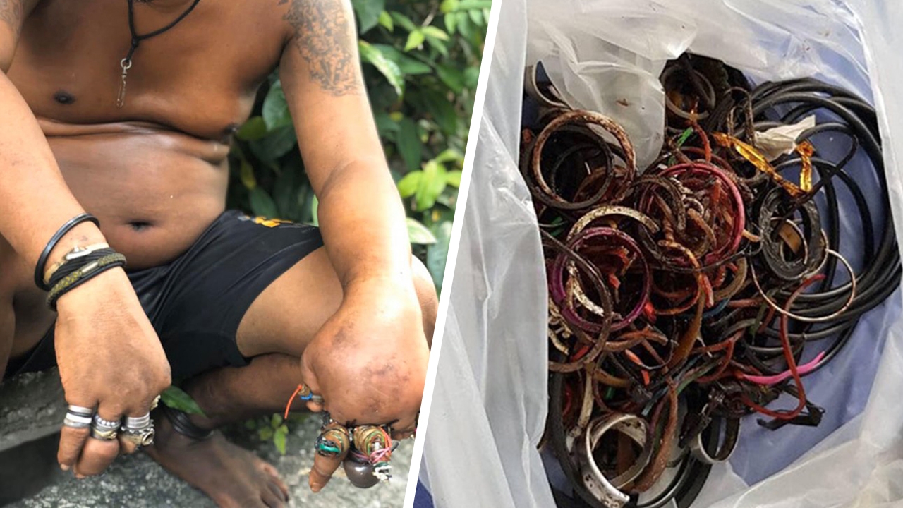 หนุ่มสติไม่ดียอมไป รพ.แล้ว เร่งช่วยตัดแหวน-หนังยาง รัดนิ้วจนบวมเป่ง