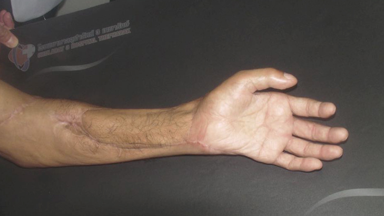 เหมือนปาฏิหาริย์ หมอผ่าตัดช่วยคนไข้แขนเหวอะ นิ้วเกือบขาด ไม่ต้องตัดทิ้ง