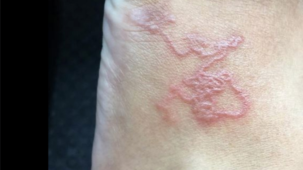 เตือนคนไม่ชอบใส่รองเท้า พยาธิยั้วเยี้ย ไชทะลุผิวหนัง เข้าสู่กระแสเลือด