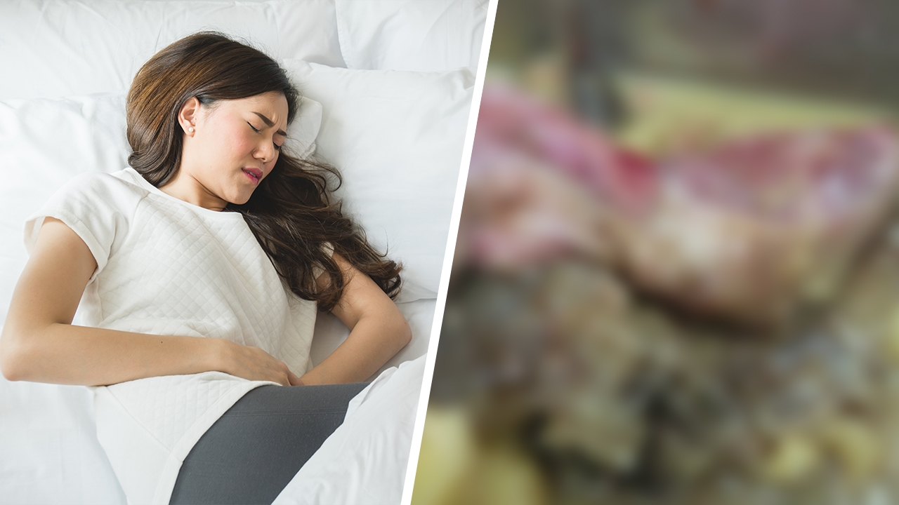 ปวดท้องน้อย คลื่นไส้ อย่าชะล่าใจ เอกซเรย์เจอก้อนเนื้อ เต็มไปด้วยผม กระดูก