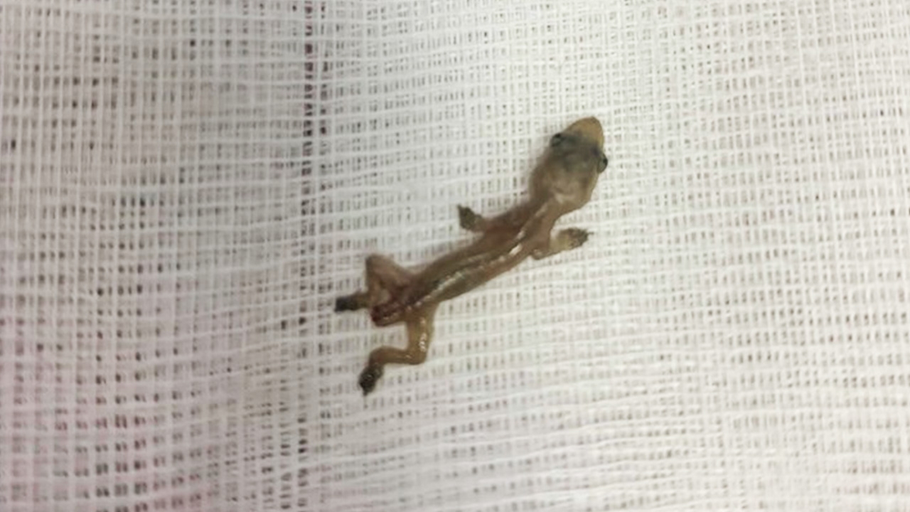 หมอช็อก คนไข้หูอื้อมา 2 วัน ส่องเจอ "จิ้งจก" ตัวใหญ่ ดิ้นอยู่ในรูหู