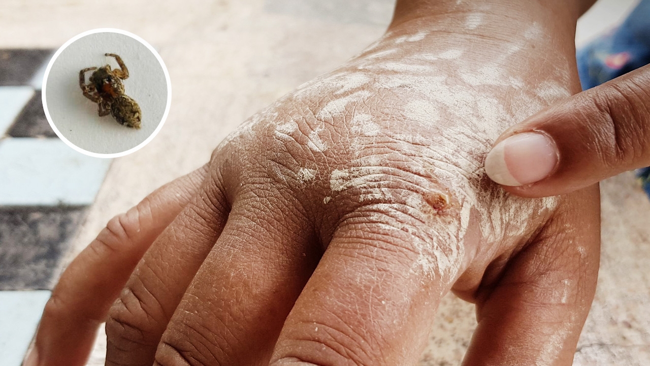 สาวใหญ่ถูกแมงมุมกัด เป็นแผลบวมไหม้ ปวดตามข้อทั่วร่างกาย