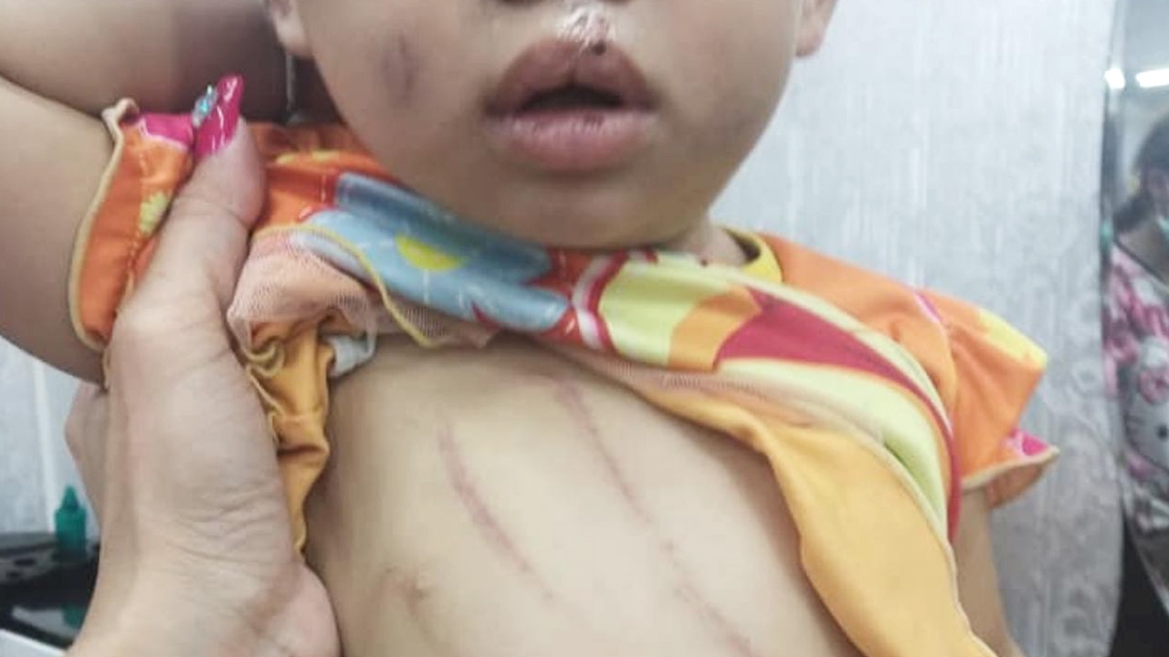 แม่เลี้ยงเดี่ยวช้ำใจ ลูกวัยขวบเศษถูกคนจ้างเลี้ยงทำร้าย เนื้อตัวมีแต่แผล