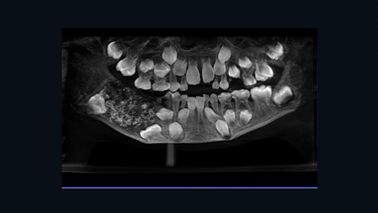 เด็กอินเดียบ่นปวดฟัน หาหมอถึงช็อก เจอฟัน 526 ซี่อยู่ในปาก