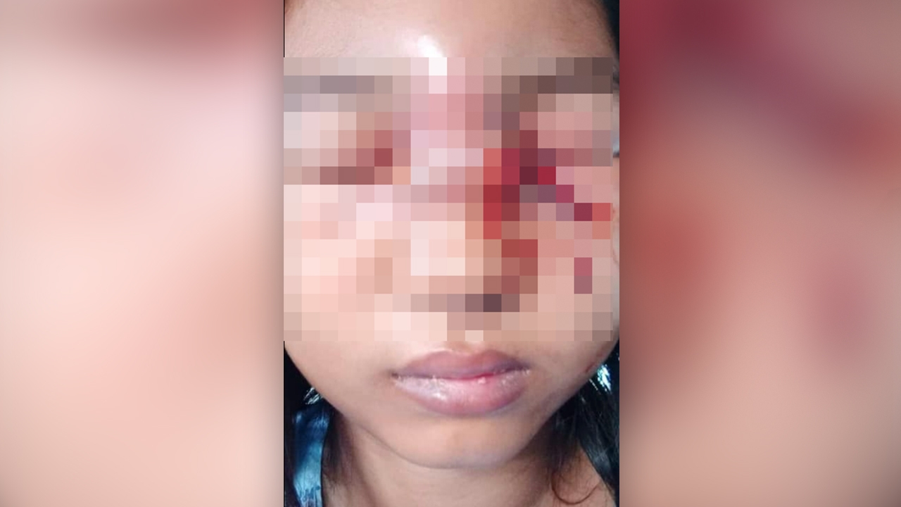 สาวเสริมจมูกติดเชื้อรุนแรง ตาบวม เลือดพุ่งจากแผล เสี่ยงช็อกต้องผ่าตัดด่วน