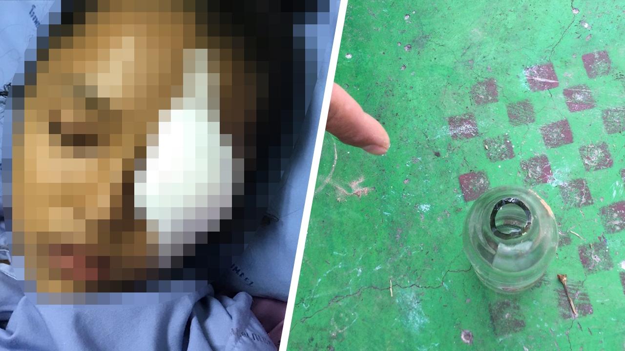 แม่อ้างครูกินเหล้าแล้วลืมเก็บ เด็กเล่นซนเปิดฝาขวดกระเด็นโดนลูก ตาเกือบบอด