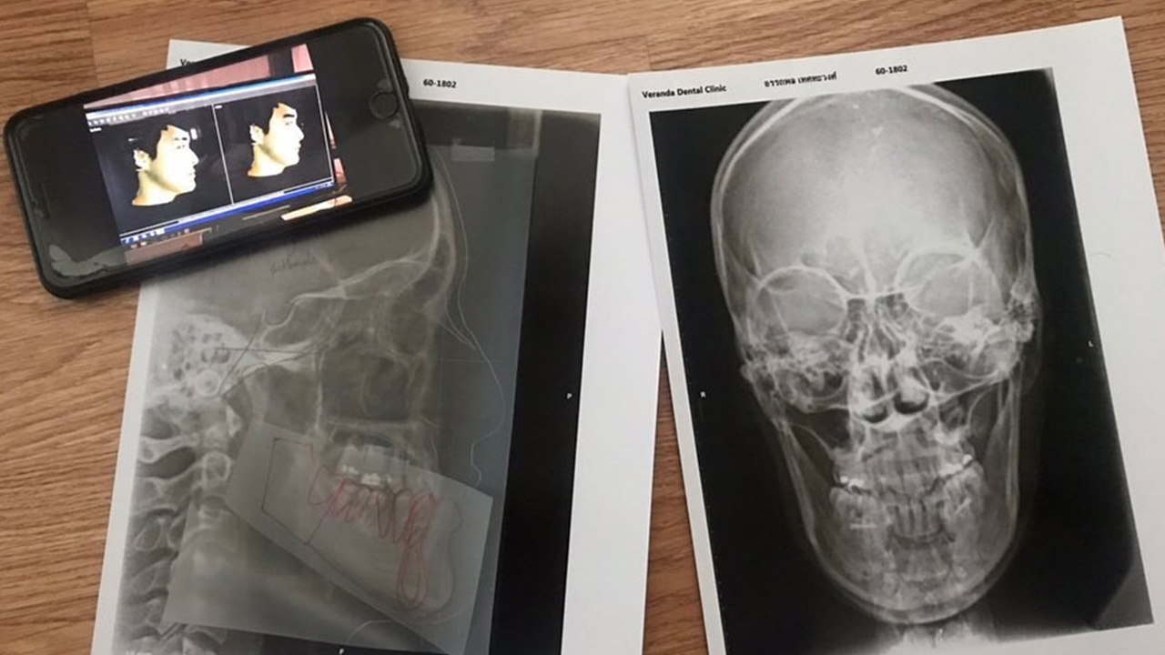 ลูกชายตลกดัง อยากเป็นปกติ ยอมเจ็บตัวผ่าตัดขากรรไกร