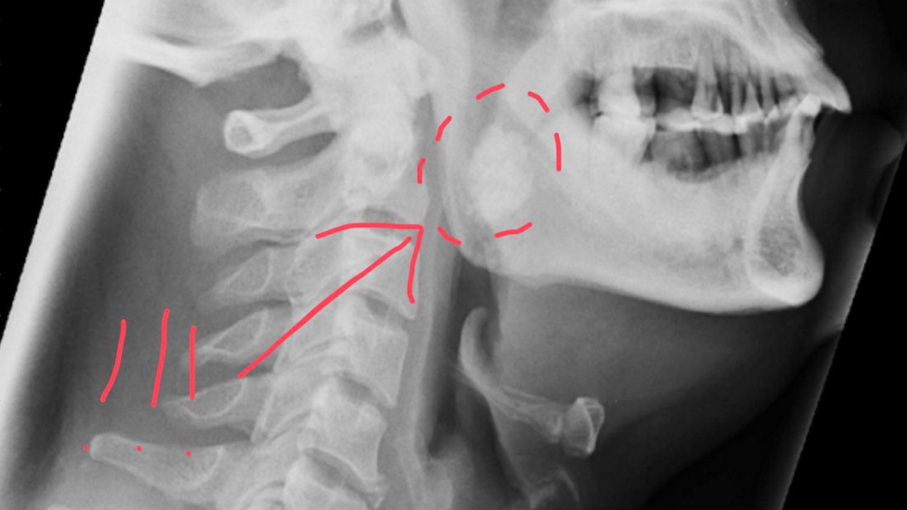 กลืนแล้วเจ็บคิดว่าก้างติดคอ สุดท้ายผ่าเจอ"นิ่วทอนซิล"ขนาดใหญ่กว่า 2 ซม.